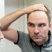 Paulo.Costa Hair Transplant: The Ultimate Solution for Hair Loss?